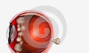 Pars planitis is an eye disease where the middle layer of the eye, called the uvea, becomes inflamed