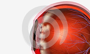 Pars planitis is an eye disease where the middle layer of the eye, called the uvea, becomes inflamed