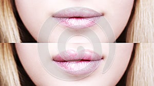 Part of face, young woman close up. plump lips after filler injection.