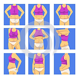 Part of Female Overweight Body Set, Human Figure After Weight Loss, Front, Back and Side View, Obesity and Unhealthy