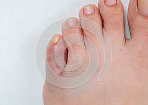 Part of the foot, a bruise is visible on the little toe. Top view, on a light background