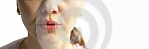 Part of a young woman face with red bubbles of virus herpes on lips Medicine, treatment. Long horizontal banner with