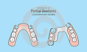 Partial Dentures illustration vector on blue background. Dental photo