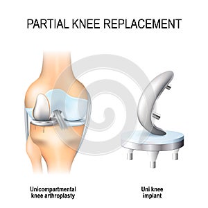 Partial knee replacement. photo