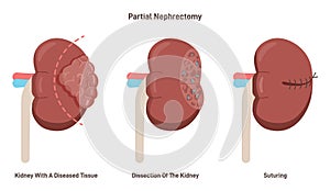 Partial nephrectomy surgery. Diseased swelling tissue surgical removal.