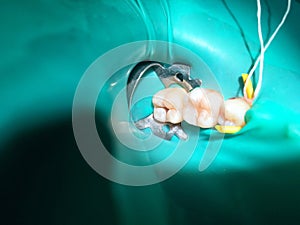 The partial pulpotomy or root canal treatment in child`s molar tooth of Asian child Bangkok; Thailand May 20, 2018