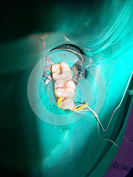 The partial pulpotomy or root canal treatment in child`s molar tooth of Asian child Bangkok; Thailand May 20, 2018
