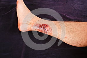 Partial thickness or third-degree burn on the leg