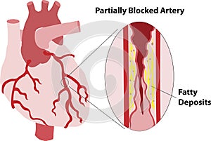 Partially Blocked Coronary Artery photo