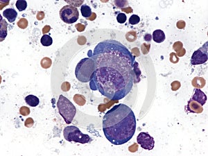 Parvovirus infection. Bone marrow. photo