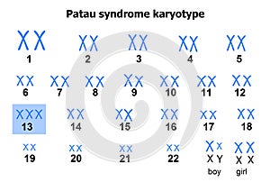 Patau syndrome karyotype photo