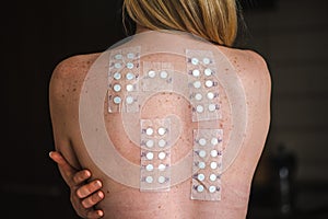 Patch test on the naked shoulder and back of a young blonde hair girl