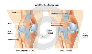 Patellar dislocation photo
