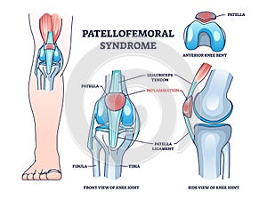 Patellofemoral pain syndrome with anatomical knee condition outline diagram