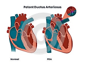 Patent ductus arteriosus with normal heart anatomy. Illustration of the congenital heart anomaly photo