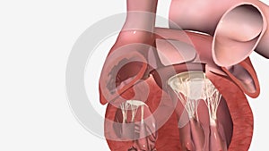 Patent foramen ovale is an abnormal hole present in the wall between the two upper chambers of the heart, or atria.