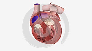 Patent foramen ovale is an abnormal hole present in the wall between the two upper chambers of the heart, or atria.