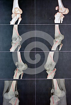 patent popliteal artery and its bifurcations tibial and peroneal arteries on a patient with bilateral metaphyseal genu varum photo