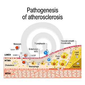 Pathogenesis of atherosclerosis