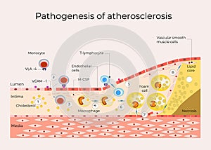 Pathogenesis of atherosclerosis medical illustration poster