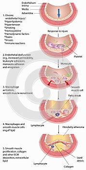 pathogenesis of atherosclerotic plaque in blood vessels
