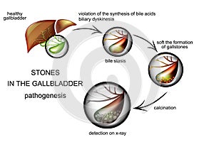 The pathogenesis of gallstones