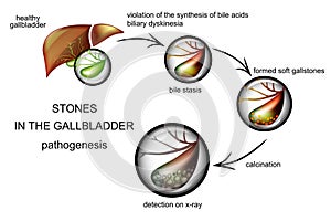The pathogenesis of gallstones