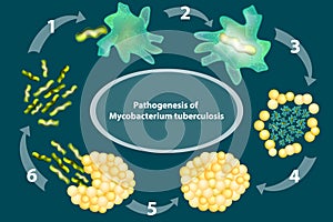 Pathogenesis of Mycobacterium tuberculosis.