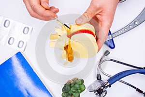 Pathology of ganglion of the spinal cord as cause of back pain. A neurologist or traumatologist shows patient during consultation