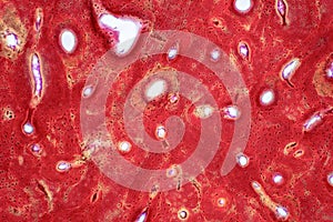 Pathology of human compact bone tissue under light microscope view photo