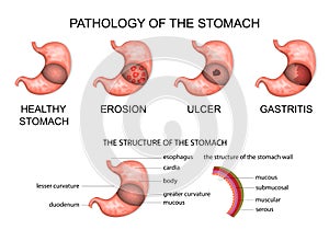 Pathology of the stomach