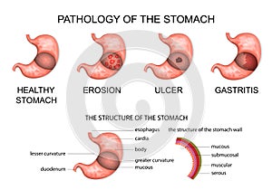 Pathology of the stomach photo