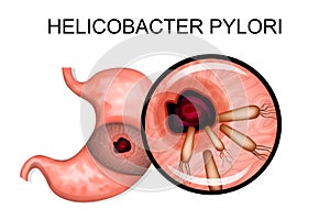 Pathology of the stomach. Helicobacter pylori photo