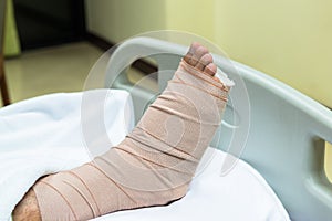 Patient with broken leg in cast and bandage