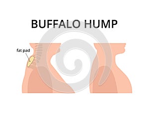 Patient with buffalo hump photo