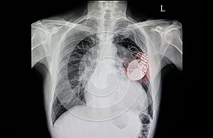 patient with cardiac pacemaker photo