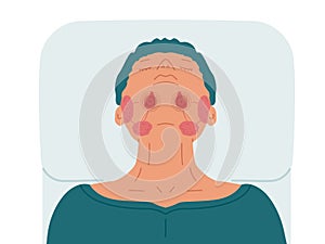 A patient with diseased sublingual salivary glands photo