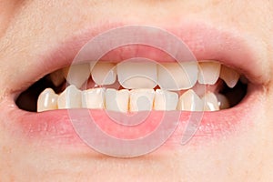 Patient with dislocated jaw and malocclusion, temporomandibular joint dysfunction, close-up.