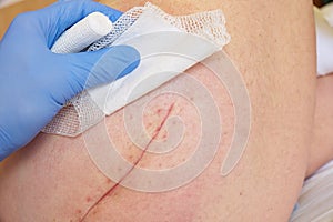 Patient with fresh long scar on hip lay in hospital bad. Nurse hand clear the skin.