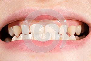 Patient with gingival smile, large gums and small teeth, microdentia, close-up photo