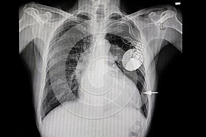 a patient with heart enlargement and a cardiac pacemaker