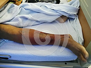 A patient hospitalized on bed and resting with leg injury background.