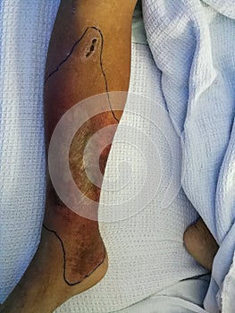 A patient hospitalized on bed and resting with leg injury background.