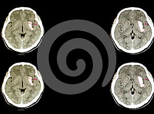 a patient with a large hematoma in the brain