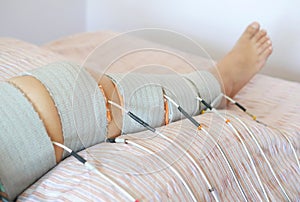 Patient Leg physiotherapy and rehabilitation by electrostimulation therapy to decrease pain and improve mobility.