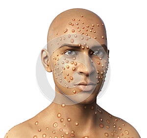 Patient with monkeypox, 3D illustration photo