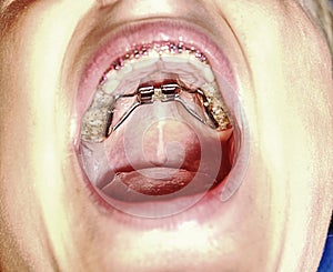 Patient with Palatal expansion frame of upper teeth.