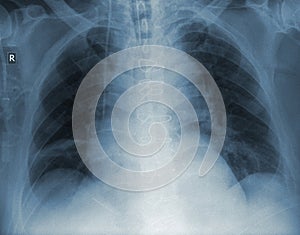 Patient radiogram with health pathology photo