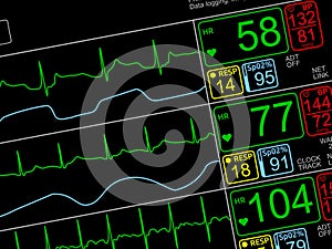 Patient`s vital signs on ICU monito