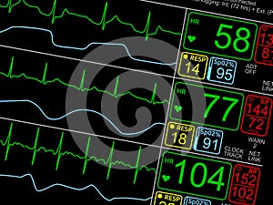 Patient`s vital signs on ICU monitor